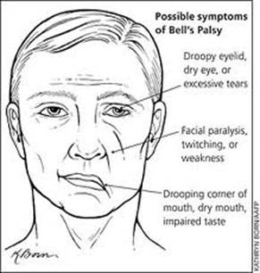 paralisis facial philes fisioterapia 1.jpg