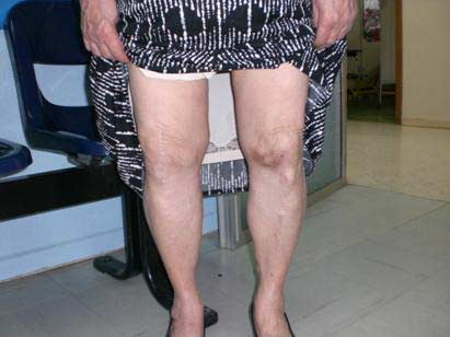 artrosis de rodilla