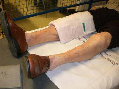 artrosis de rodilla