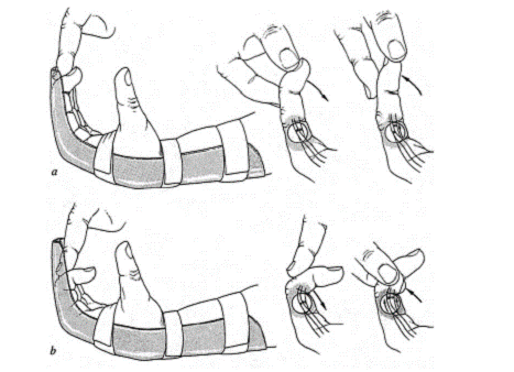 Fisioterapia flexores de la mano