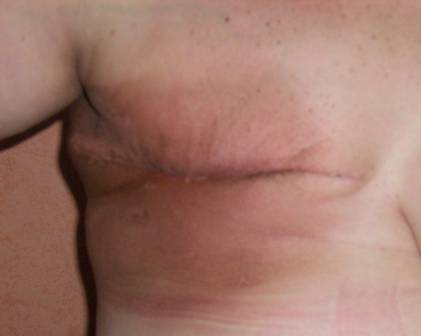 cirugía reconstructiva de mamas