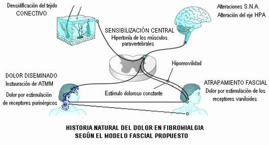 Historia natural del dolor fibromiálgico