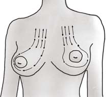 hypertrophie des seins