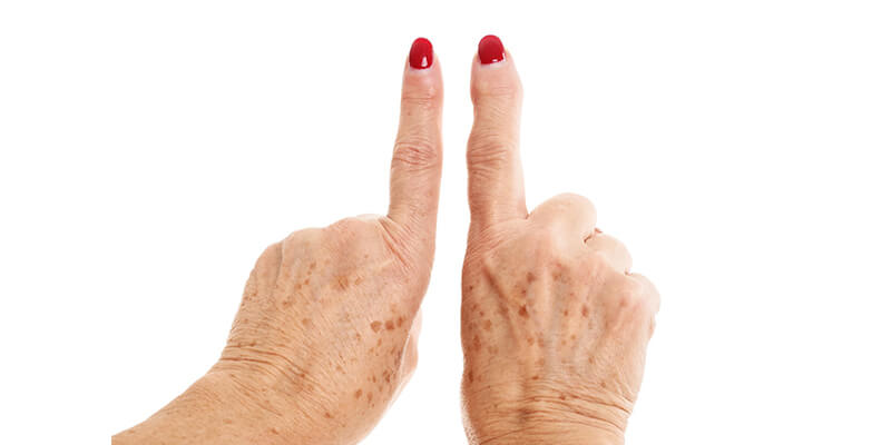 Un ensayo clínico avala la eficacia de la magnetoterapia en la artrosis  erosiva de manos - Blog de fisioterapia