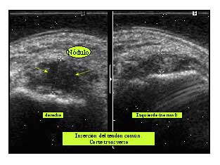 Epicondilitis