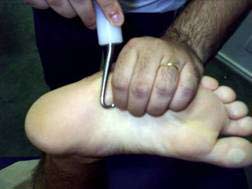 fascitis plantar bilateral