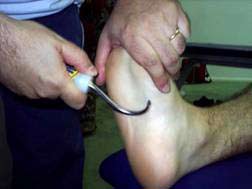 fascitis plantar bilateral