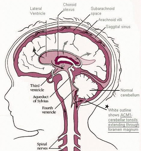 Arnold Chiari