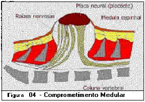 Mielomeningocele