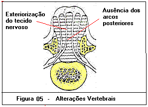 Mielomeningocele