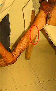 lesiones ligamentosas del codo