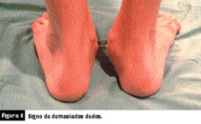 Fisioterapia pie plano