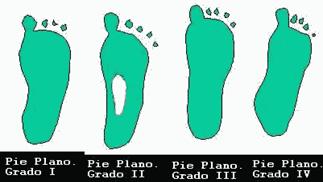 Fisioterapia pie plano