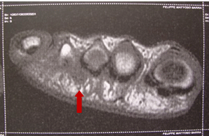 neuroma de Morton