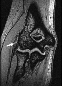 Epicondilitis o epicondilosis