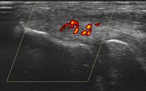 Epicondilitis o epicondilosis