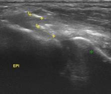 Epicondilitis o epicondilosis