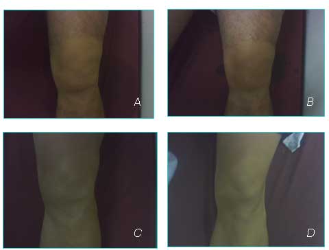 Manejo fisioterapéutico de menisectomia