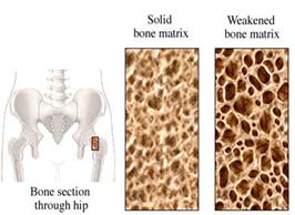 ejercicios sarcopenia