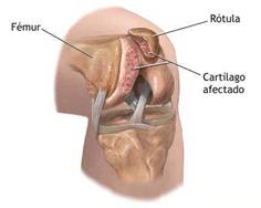 Analisis biomecanico de rodilla