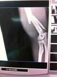 Fisioterapia en fractura supracondílea de húmero