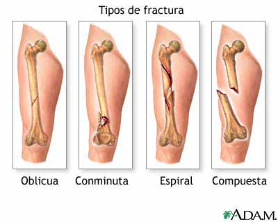Tipos de fractura (1)
