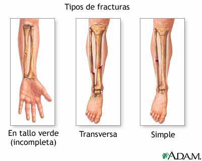 Tipos de fractura (2)