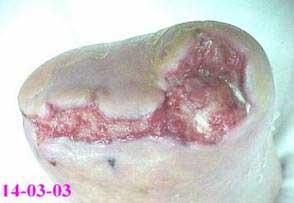 tratamiento de heridastratamiento de heridas