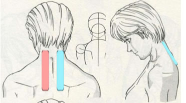 Aplicaciones del vendaje neuromuscular en las cervicalgias.