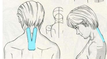 Aplicaciones del vendaje neuromuscular en las cervicalgias.