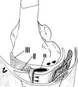 Bursitis del ligamento colateral medial de la rodilla