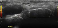 Bursitis del ligamento colateral medial de la rodilla