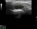 Bursitis del ligamento colateral medial de la rodilla