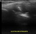 Bursitis del ligamento colateral medial de la rodilla