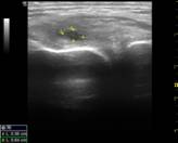 Bursitis del ligamento colateral medial de la rodilla