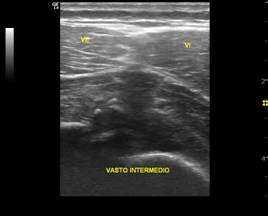 Miositis osificante traumática