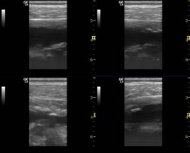 Miositis osificante traumática