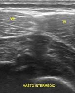 Miositis osificante traumática