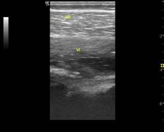 Miositis osificante traumática