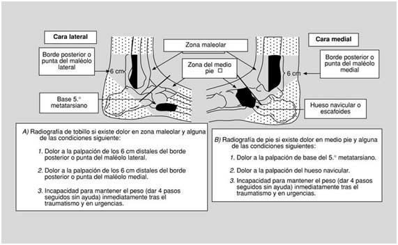 Esguince de tobillo