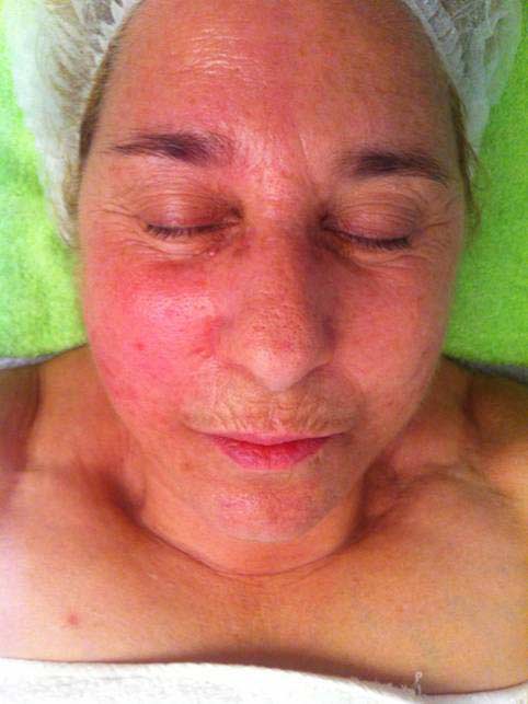  miorregeneración facial