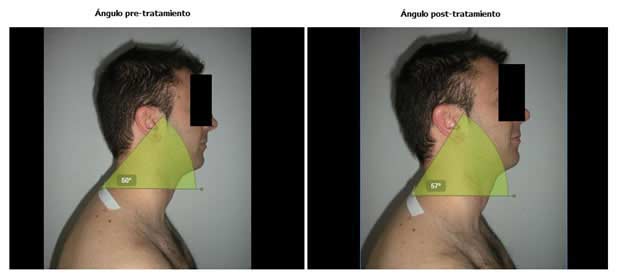 articulación temporomandibular