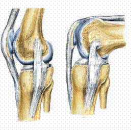 artrosis de rodilla