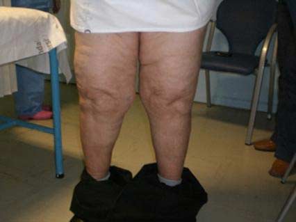 Tratamentul conservator al osteoartrozei articulațiilor mari
