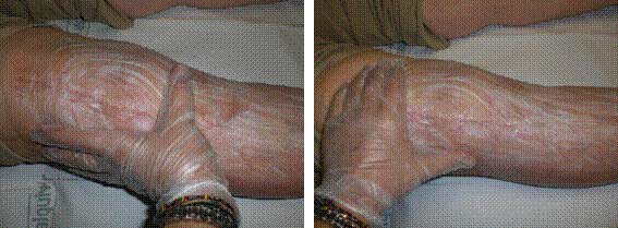 Tratamentul artrozei deformante a articulațiilor mici ale mâinilor