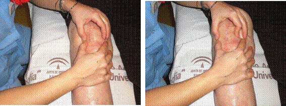 Tratamentul artrozei deformante a articulațiilor mici ale mâinilor - bicaz-turism.ro