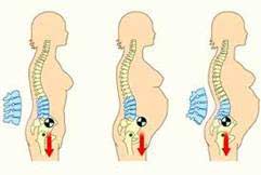 dolor lumbar en gestantes