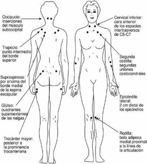 Fibromialgia