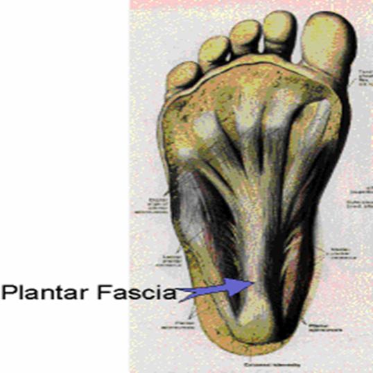 fascitis plantar