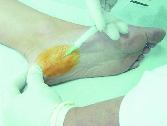 fascitis plantar